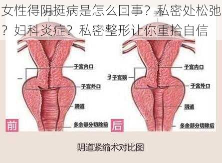 女性得阴挺病是怎么回事？私密处松弛？妇科炎症？私密整形让你重拾自信